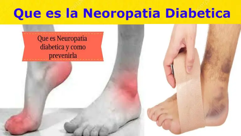 Neuropatia diabetica- Tipos de Neuropatia