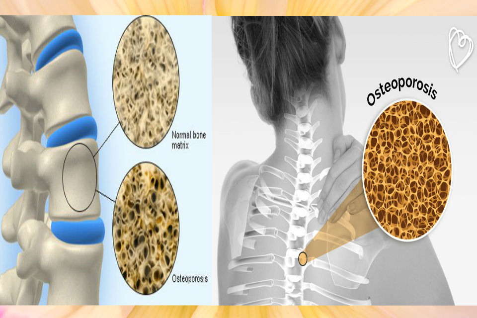 ¿Qué es la osteoporosis? – La relación entre la diabetes y la osteoporosis-El tratamiento de la osteoporosis.