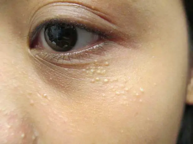 Cómo eliminar milium o Milia, esas bolitas blancas que salen en la cara, alrededor de los ojos, y en otras partes del cuerpo