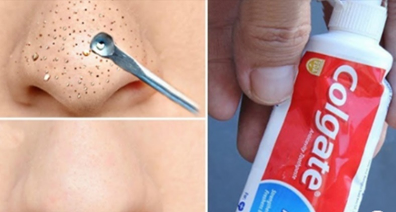 Tratamiento eficaz para las espinillas y puntos negros en la nariz y el rostro.